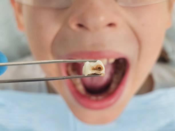 Best Emergency Tooth Extraction in Boyne City, MI